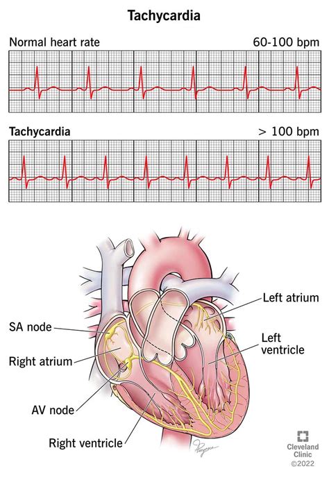 Tachycardia (High Heart Rate): Symptoms & Treatment .